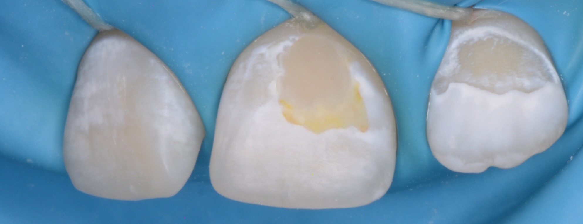 Гипоплазия эмали: почему разрушаются зубы ребенка