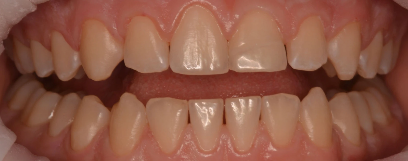 Профессиональная гигиена у подростка 13 лет - После